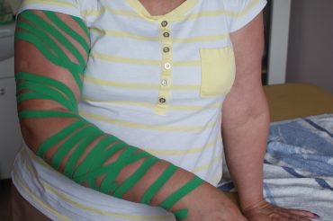 Rozszerzamy terapię amazonek o nową metodę – Kinezjotaping